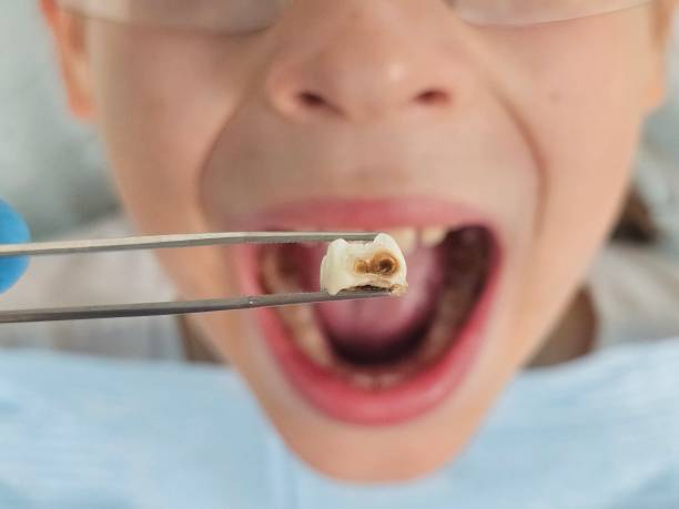 Best Emergency Root Canal Treatment in Matthews, NC