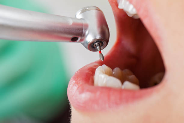 Best Emergency Tooth Extraction in Matthews, NC